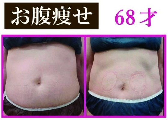 バスタイムボミー　お腹痩せ 浮腫 バスタイムボミー お腹痩せ 浮腫